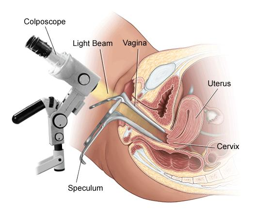 Кольпоскопия
