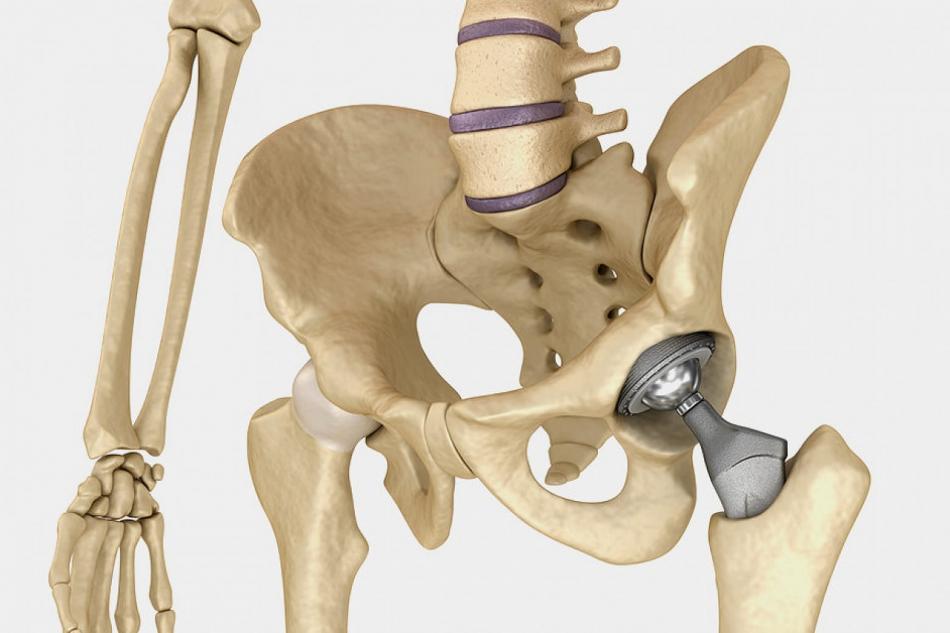 Стоимость эндопротезирование тазобедренного сустава.