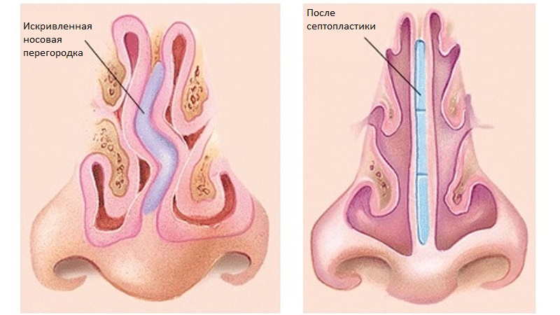 Септопластика - цены и отзывы